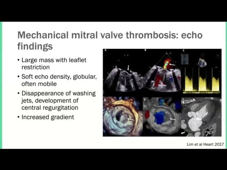 Evaluación ecocardiográfica de válvulas mitrales protésicas