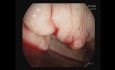 Resangrado varices del fundus - Cianoacrilato + Inyección de gel AB