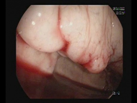 Resangrado varices del fundus - Cianoacrilato + Inyección de gel AB