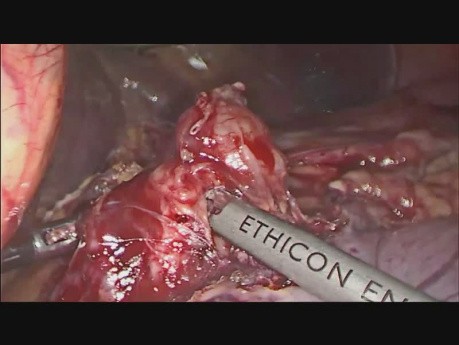 Gastrectomía total laparoscópica con una anastomosis esófago-yeyunal