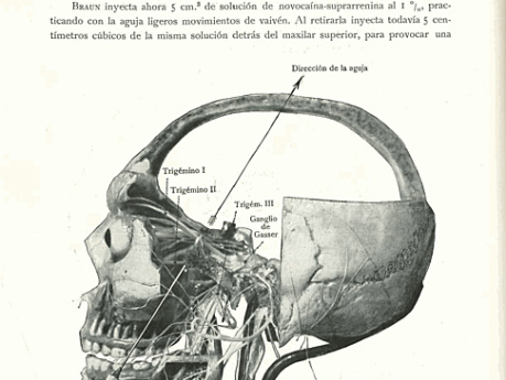 Anestesia Local