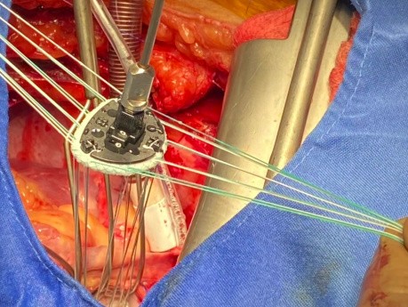 Cirugía de revascularización coronaria + Reparación de aneurisma del ventrículo izquierdo + Reparación de la válvula mitral