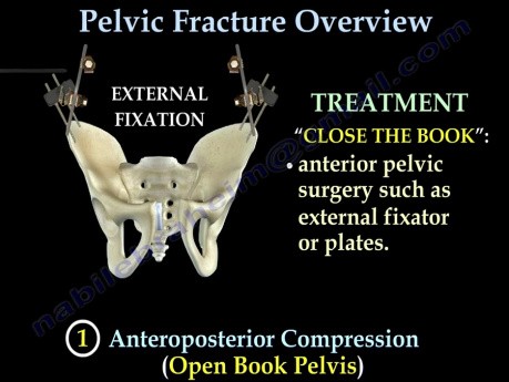 Fracturas pélvicas - video-clase