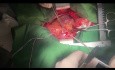 Cirugía de válvula tricúspide sin circulación extracorpórea en paciente con endocarditis bacteriana