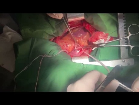 Cirugía de válvula tricúspide sin circulación extracorpórea en paciente con endocarditis bacteriana