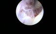 Metaplasia osea en paciente postmenopausica
