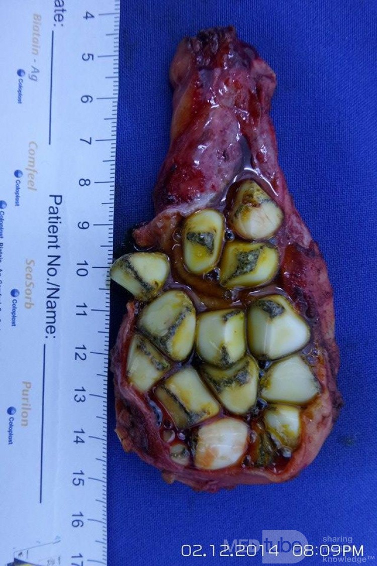 Colecistectomía laparoscópica con múltiples piedras