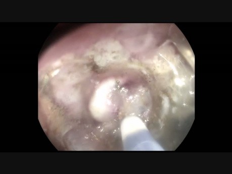 DSE de LST rectal distal en paciente después de trasplante de hígado