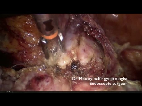 Abdomen con cicatriz. Obesidad mórbida. Histerectomía compleja.