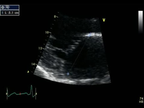 Insuficiencia mitral