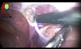 Desconexión del saco del peritoneo en una hernia inguinal coexistente con un hidrocele comunicante ipsilateral en un niño de 7 años