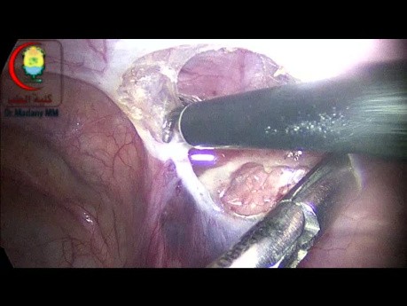 Desconexión del saco del peritoneo en una hernia inguinal coexistente con un hidrocele comunicante ipsilateral en un niño de 7 años