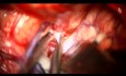 Clipado de aneurisma de bifurcación de la arteria cerebral media