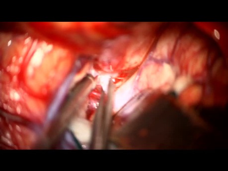 Clipado de aneurisma de bifurcación de la arteria cerebral media