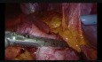 Gastrectomía laparoscópica periférica