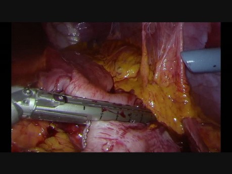 Gastrectomía laparoscópica periférica