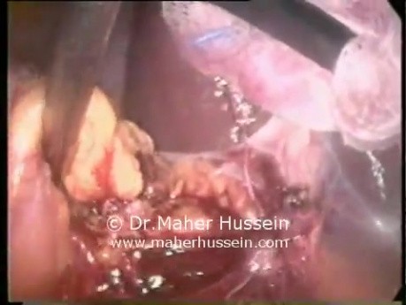 Nefrectomía derecha del donante - abordaje laparoscópico