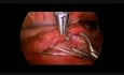 Reparación toracoscópica de atresia esofágica