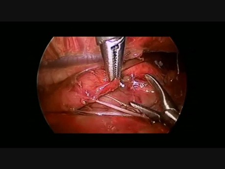 Reparación toracoscópica de atresia esofágica