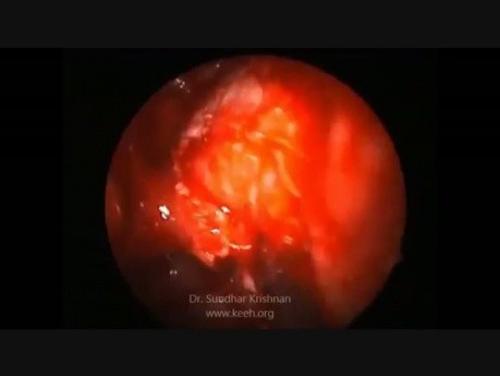 Sinusitis fúngica recurrente con extensión orbitaria