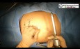 Cirugía laparoscópica de un quiste dermoide ovárico izquierdo
