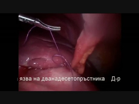 Operación laparoscópica para úlcera péptica perforada