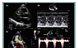 Ecocardiografía de Miocardiopatía Hipertrófica (MCH)
