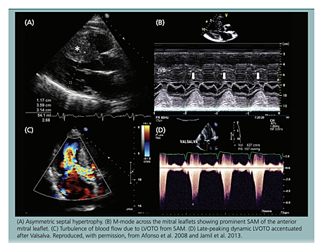 Ecocardiografía de Miocardiopatía Hipertrófica (MCH)