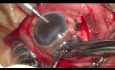Una lesión de globo abierto descuidada manejada usando lentes Scleral Tuck para salvar la visión
