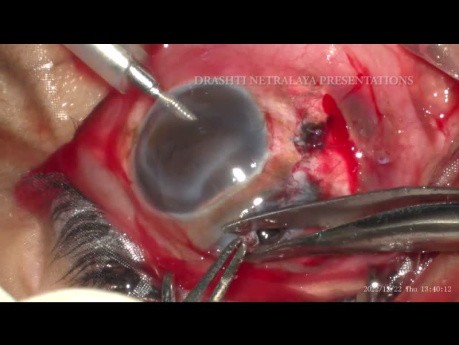 Una lesión de globo abierto descuidada manejada usando lentes Scleral Tuck para salvar la visión