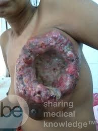 Hongos en el tumor del seno izquierdo