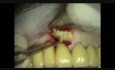 Preservación alveolar - extracción del pilar de un puente (diente 11)