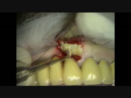 Preservación alveolar - extracción del pilar de un puente (diente 11)