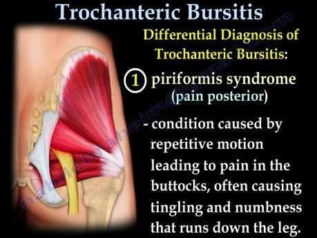 Bursitis trocantérea - descripción y tratamiento