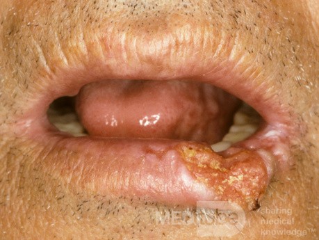 Carcinoma de células escamosas del labio inferior