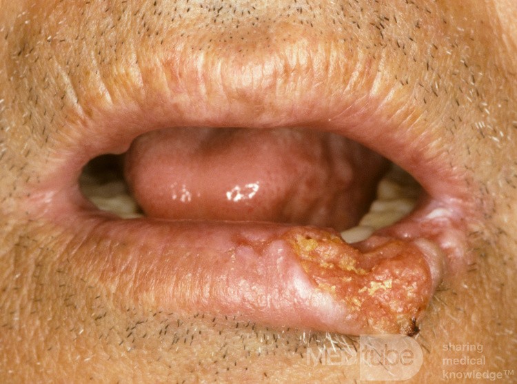 Carcinoma de células escamosas del labio inferior