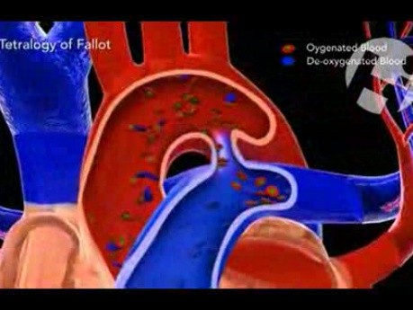 Arterias - tetralogía de Fallot