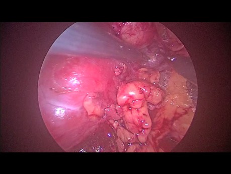 Cirugía Laparoscópica Retroperitoneal para Extirpar Tumor Renal Quístico