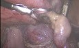 Fibroide de ligamento ancho de rara localización. Histerectomía laparoscópica.