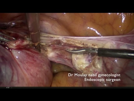Histerectomía subtotal ambulatoria para adenomiosis