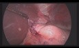 Cirugía de preservación de órganos para el tumor submucoso del esófago abdominal