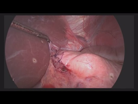 Cirugía de preservación de órganos para el tumor submucoso del esófago abdominal