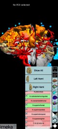 Planificación quirúrgica con neuronavegador en paciente con lesión de masa intracraneal. Glioma de alto grado.