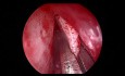 Septoplastia endoscópica para la desviación del tabique nasal