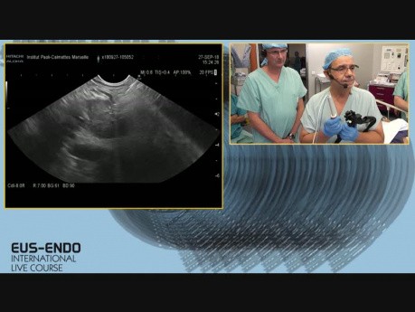 USE guiada por ARF de metastasis pancreática