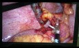 Apendicectomia Por Videolaparoscopia