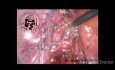 Colecistectomía laparoscópica y exploración del conducto biliar común