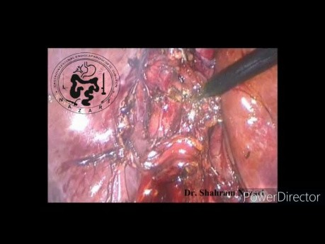 Colecistectomía laparoscópica y exploración del conducto biliar común