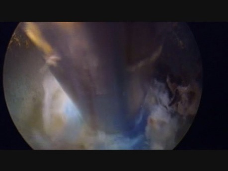 Anuloplastia y Nucleoplastia Endoscópica Lumbar Percutánea (PELAN) de L4 Izquierdo, Cirugía Endoscópica de Columna