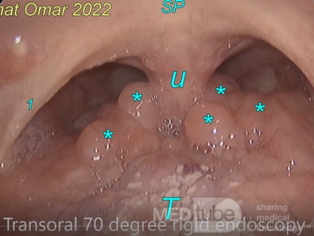 Amígdalas linguales